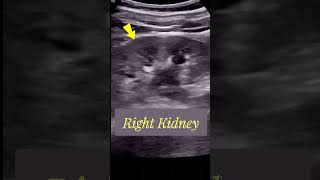 Tracing the Large  Obstructed Ureteric stone  Ultrasound [upl. by Tegirb]