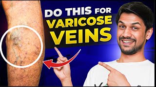 VARICOSE VEINS explained under 10 minutes  Saurabh Bothra Yoga [upl. by Jer71]