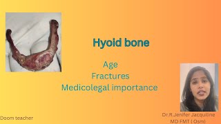 Hyoid bone Age Types of fractures Medicolegal importance  Forensic Medicine [upl. by Ogdon851]