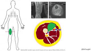 Soft Tissue Sarcoma [upl. by Yhcir917]