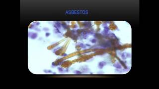 pathology  drTahseen  Lung Tumers 2 [upl. by Melia]