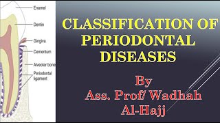 10 Classification of periodontal diseases  Dr Wadhah Periodontology lectures د وضاح الحاج [upl. by Oirifrop]