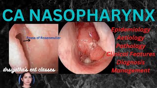 199Nasopharyngeal Carcinoma Part 13 epidemiology aetiologyclinical features nasopharynx [upl. by Laius]