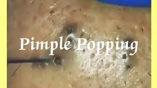 Pimple amp Blackheads Popping  9 [upl. by Carmella]