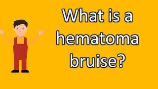 What is a hematoma bruise  Find Health Questions  Best Health TIPS [upl. by Atinihc]