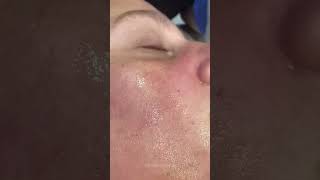 Clogged Pores amp how we unclog them  Dr Medispa [upl. by Qulllon230]