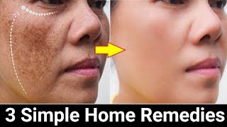 Remove Face Pigmentation Naturally [upl. by Imojean]