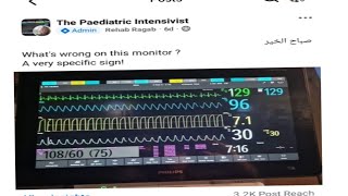 whats wrong in this monitor Dr Rehab Ragab Elseidy Capnogram capnography [upl. by Uokes258]