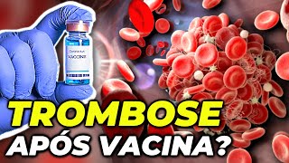 COVID VACINA DE OXFORD ASTRAZENECA CAUSA TROMBOSE [upl. by Vivyanne646]