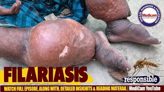 🦟Filariasis Lymphatic Filariasis Causes Symptoms and Treatment Options [upl. by Isacco7]