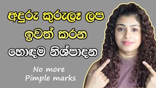 අඳුරු කුරුලෑ ලප ඉවත් කරන හොඳම නිෂ්පාදන ❘ Dark Spots Treatment Sinhala ❘ Pimple Treatment Sinhala [upl. by Timoteo758]