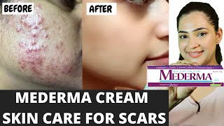 Mederma Cream Review And Uses In Hindi  दाग मिटाने की सबसे अच्छी क्रीम  mederma scars cream [upl. by Ellicec]