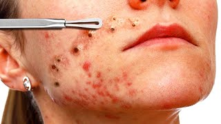 Acne Papules Causes Treatments Natural Remedies Do’s and Don’ts [upl. by Ahgiela]