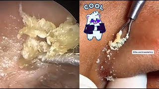 Ultimate ASMR Pimple Popping Compilation Satisfying Acne amp Blackhead Extractions for Relaxation [upl. by Rajiv559]