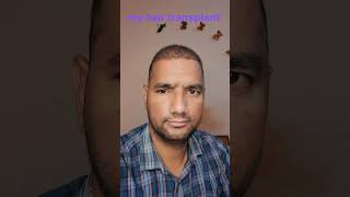 my hair transplant hairtreatment longhairtransplant hairlinetransplant [upl. by Nehemiah]