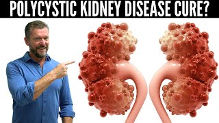 Polycystic Kidney Disease Breakthrough New Research in PKD  2024 [upl. by Retla]