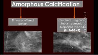 4 sonomammography ACR BIRAD breast calcification [upl. by Candra]