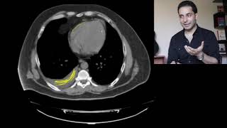 Pericardial fat pad vs pericardial effusion [upl. by Areemas754]