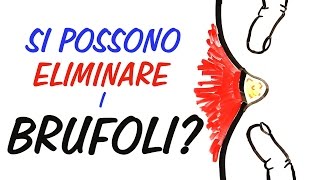 Si possono eliminare i brufoli LA SCIENZA DELLACNE [upl. by Nuawed673]