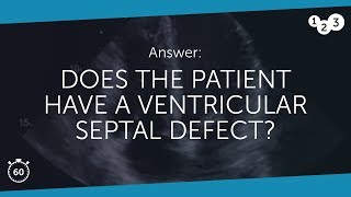 60 Seconds of Echo Teaching Answer Ventricular Septal Defect [upl. by Eliott]