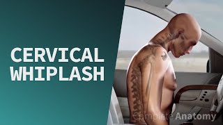 Cervical Whiplash  Trauma [upl. by Pare]