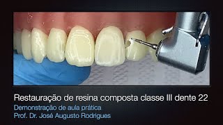 Restauração Classe III de resina composta  Demonstração no Laboratório [upl. by Heiney]