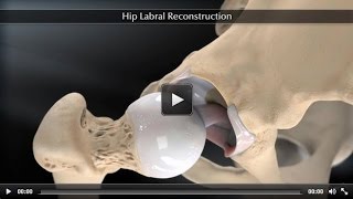 Hip Labral Reconstruction [upl. by Nnav]