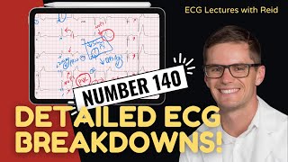 Improve your EKG Skills test yourself  ECG No 140 [upl. by Shoifet]