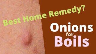 Onions for Boils Excellent Natural Remedy for Skin Abscess [upl. by Rep]