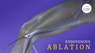 What is Endovenous Laser Ablation CARE Hospitals [upl. by Aileve638]