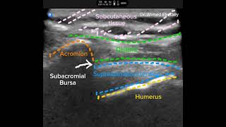 Subacromial bursa injection [upl. by Ecyned]