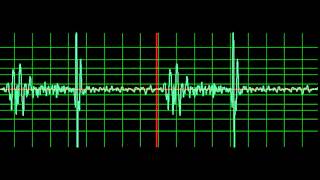 Ventricular Septal Defect normal speed [upl. by Akkahs]