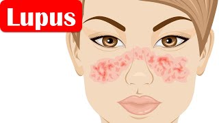 Lupus SLESystemic Lupus Erythematosus  Causes Pathogenesis Symptoms Diagnosis Treatment [upl. by Nahsin]