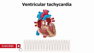 Ventricular Tachycardia [upl. by Annissa]