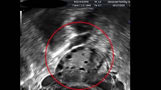 Antral Follicle Counts in Real Time [upl. by Malchy]