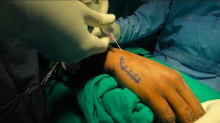 Reverse Bennetts fracture dislocation 5th metacarpal base plating procedure [upl. by Eerok]