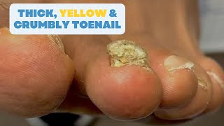 Why Is My Toenail THICK YELLOW amp CRUMBLY [upl. by Gnod]