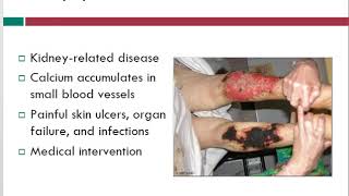 Calciphylaxis  Wound Care Topics  Free Wound Care Info  WoundEducatorscom [upl. by Corwun759]