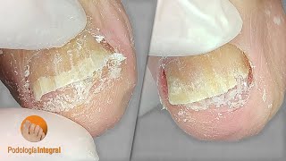 Toenails with fungus  Podological procedure [upl. by Adohr]