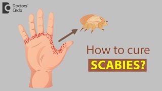 How to cure Scabies  Dr Rajdeep Mysore [upl. by Suivatnom637]