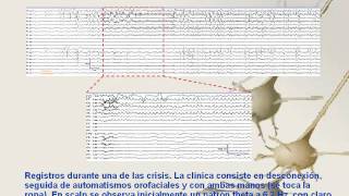 vEEG de SCALP en paciente con epilepsia del lobulo temporal [upl. by Ahsik320]