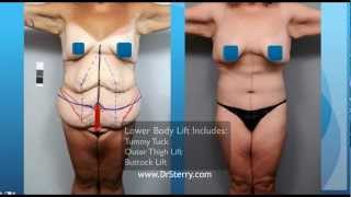 Lower Body Lift with Fleur de Lis Abdominoplasty  Dr Sterry [upl. by Beare904]