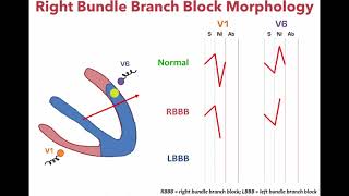 Left Bundle Branch Block and Right Bundle Bundle Branch Morphology [upl. by Symon726]