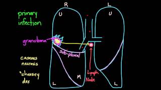 Primary and Secondary TB [upl. by Aikmat]