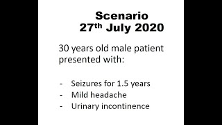 Oligodendroglioma 27th July 2020 [upl. by Eiramac]