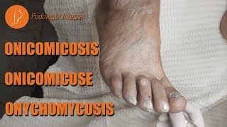 Fungus  Onychomycosis podology asmr [upl. by Duer]