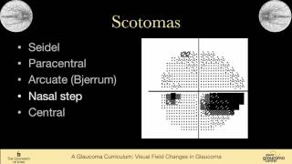 Lesions to the Visual Pathway EXPLAINED [upl. by Erasaec]