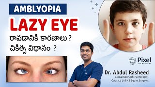 Amblyopia కారణాలు మరియు చికిత్స  Lazy Eye Causes  Lazy Eye Treatment  Lazy eye DrAbdul Rasheed [upl. by Amabel910]