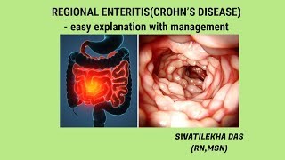 What is Crohns Disease easy explanation with management [upl. by Cohl]