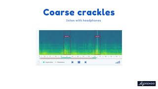 Lung sounds  coarse crackles [upl. by Dnomasor]